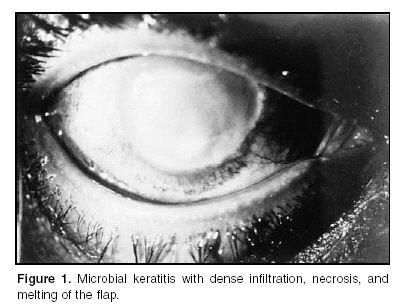 Microbial Keratitis - and they say "LASIK is Safe".